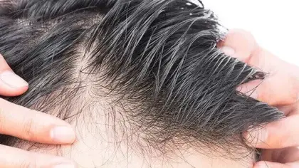 تفسير تساقط الشعر في المنام وأبرز دلالاته