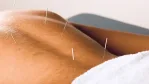 كيف يعالج الوخز بالإبر الأمراض ويستعيد توازن الجسم؟