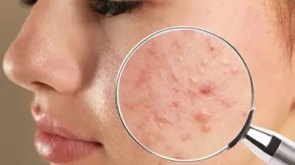تفسير حلم رؤية الحبوب والبثور في المنام