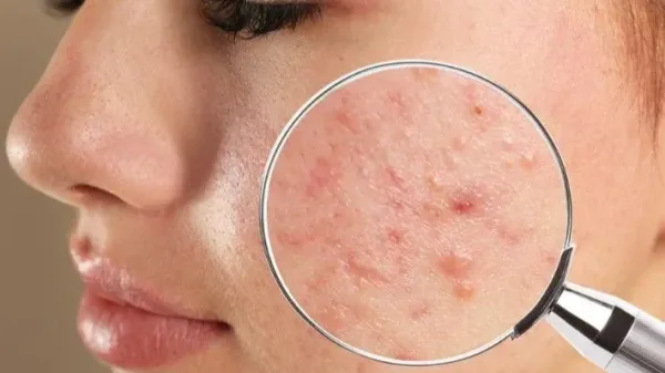ماذا تعني رؤية البثور في المنام؟