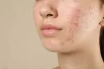 لماذا يظهر حب الشباب عند البشر وهل يصيب الحيوانات أيضاً؟