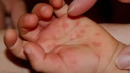 فيروس كوكساكي: الأعراض والوقاية منه