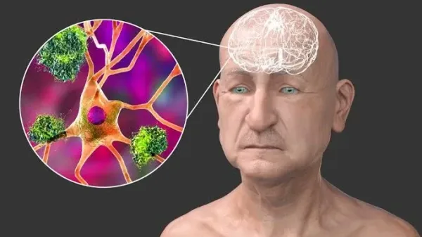 نماذج الدماغ المصغرة لدراسة خرف أجسام ليوي
