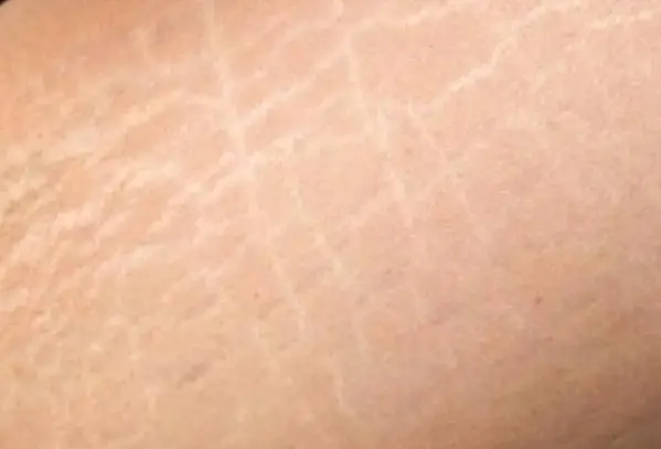 علاج السيلوليت وأسبابه