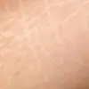 طرق علاج السيلوليت وأسبابه بين التقنيات الطبية والحلول المنزلية