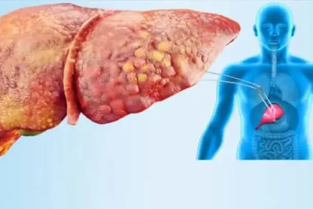 أضرار المشروبات السكرية على الكبد