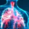 أعراض سرطان الرئة المبكرة