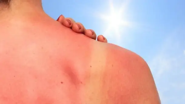 علاج حروق الشمس في المنزل