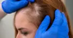 حالات صحية يكشفها شعرك قبل ظهور أعراض المرض
