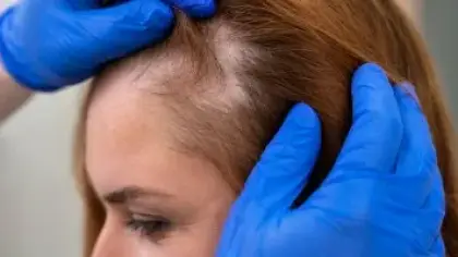 حالات صحية يكشفها شعرك قبل ظهور أعراض المرض