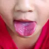 علاج حبوب لسان الأطفال الحمراء