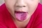 علاج حبوب لسان الأطفال الحمراء