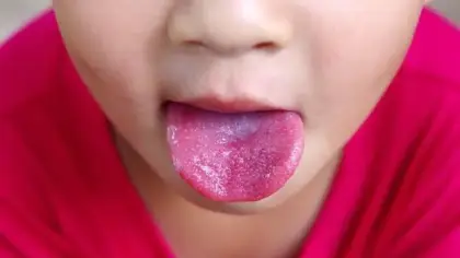 علاج حبوب لسان الأطفال الحمراء
